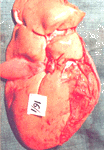 heart generalised haemorrhages.gif